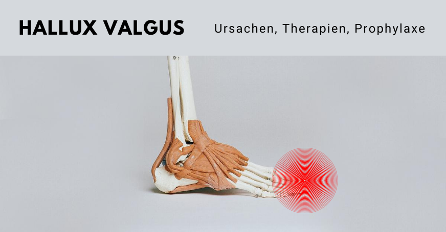 Beim Hallux Valgus handelt es sich um eine Fehlstellung im Bereich der Großzehe.