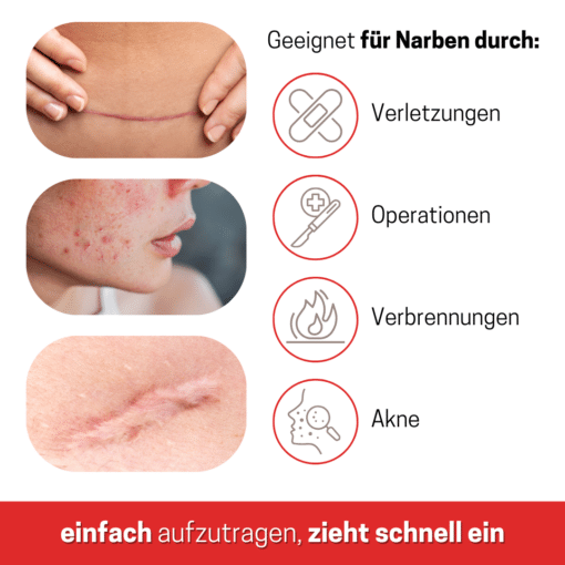 Narbengel | effektive Behandlung von Narben | nach Operationen, Verletzungen, Akne und Hautinfektionen – Bild 5